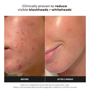 Paula's Choice 2% BHA Exfoliating Toner for Clear Skin